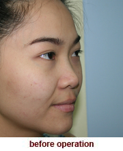 plastic_surgery_augmentation_rhinoplasty